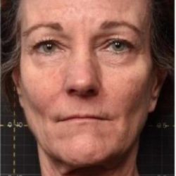 Sofwave Before & After Patient #1600